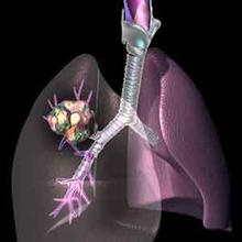 石家庄肿瘤医院浅谈诱发肺癌的病因是什么?