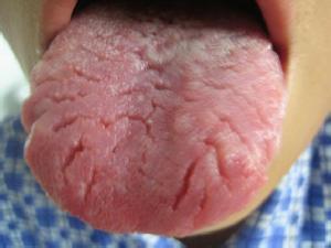 口腔干燥症的临床表现